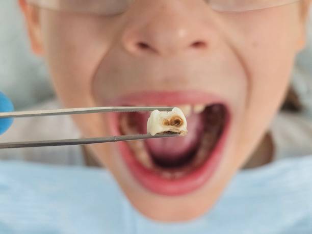 Best Emergency Wisdom Teeth Removal in Prague, OK